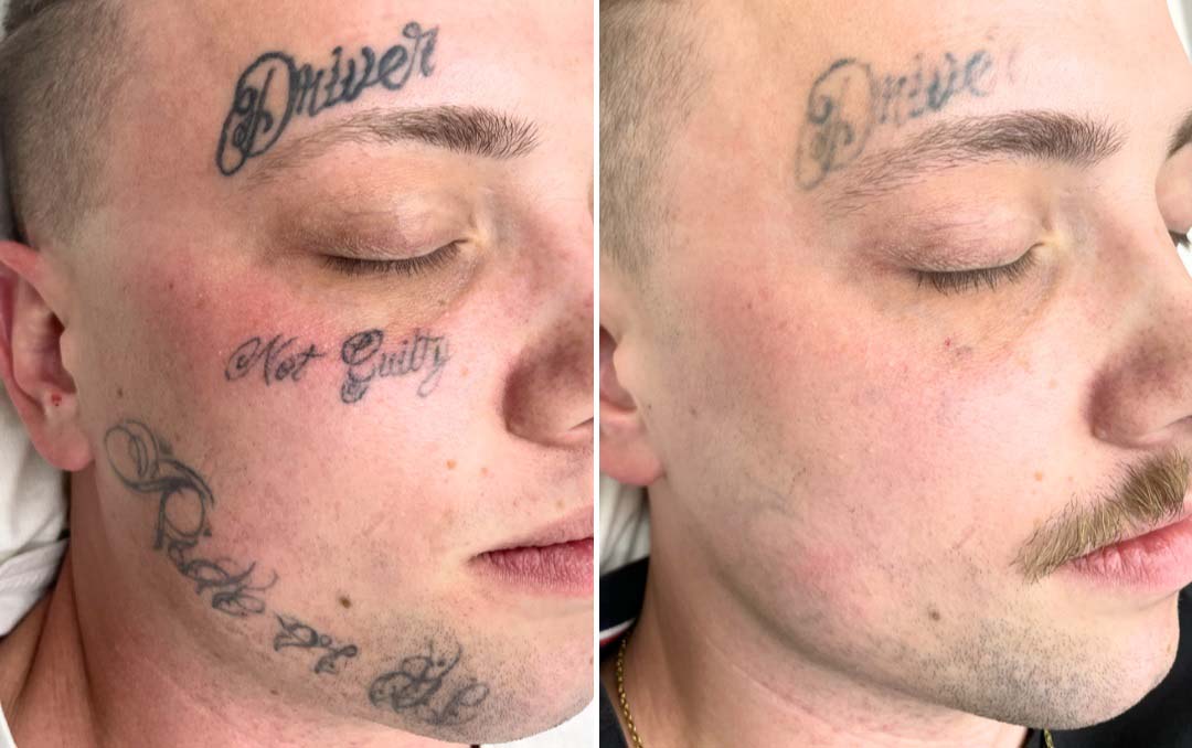 birth flower tattoo remove